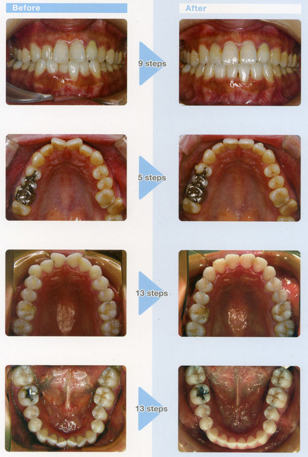 1_sp. Minor Crowding Case