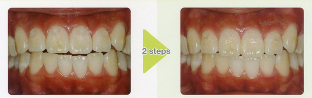 4. Extrusion Case