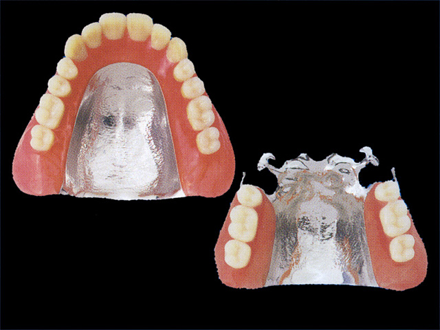 コバルトクロム床義歯
