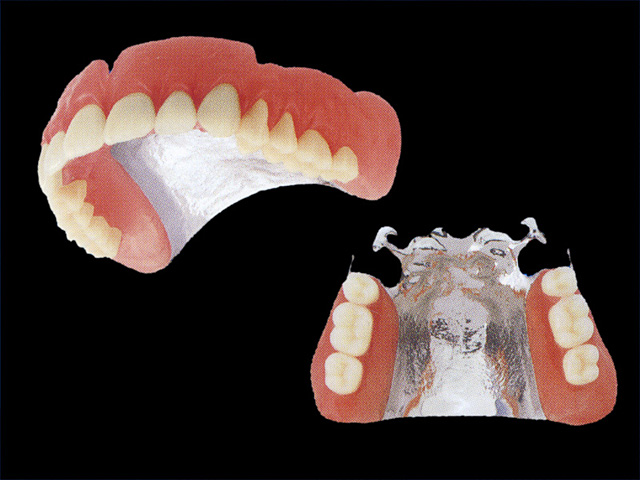 チタン床義歯