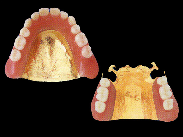 ゴールド床義歯
