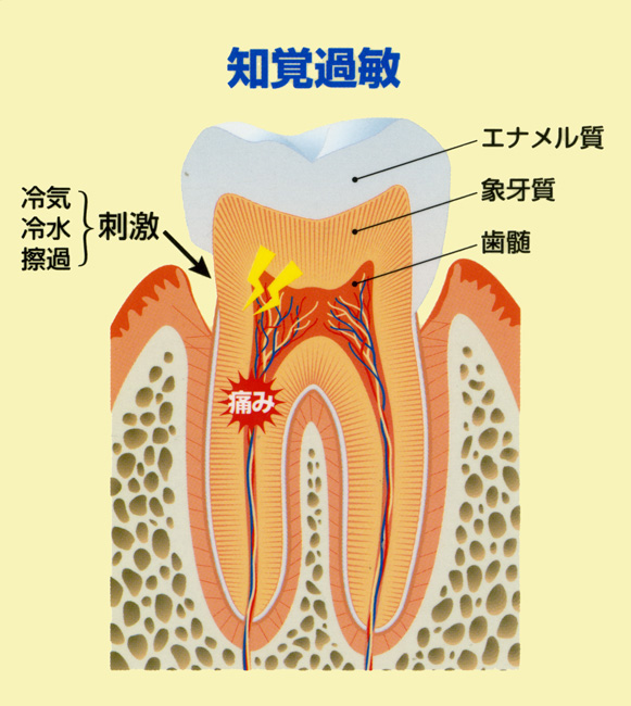 知覚過敏