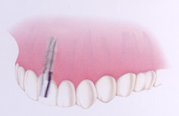 インプラントが支持する歯冠