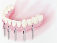 インプラント支持の固定式義歯