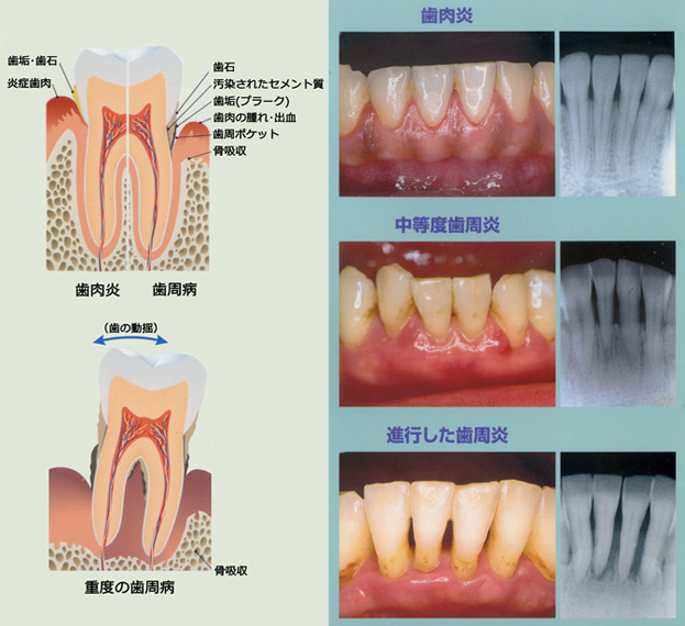 歯周病の概要