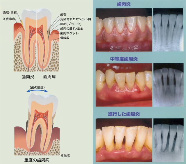 歯周病の概要