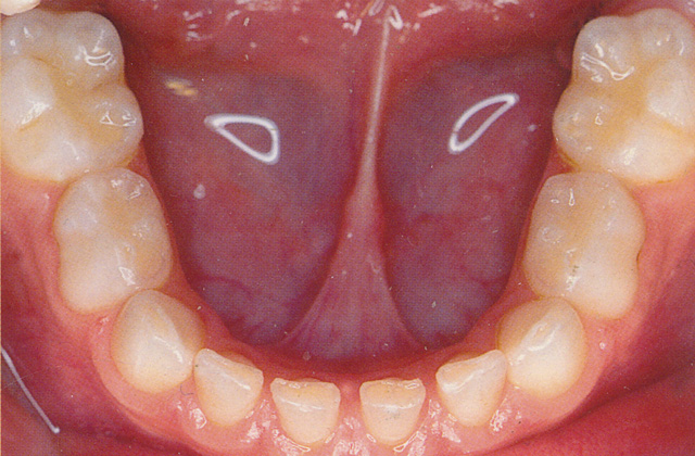 乳歯列 下顎