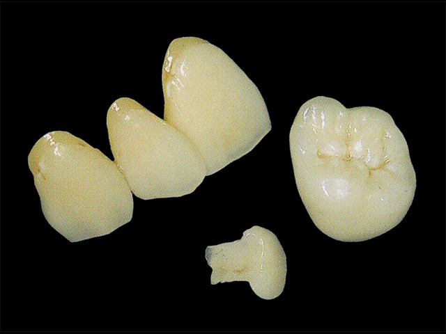 オールセラミックインレー・クラウン