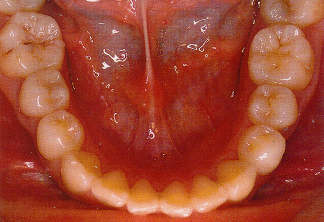 永久歯列 下顎