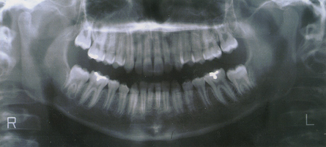 永久歯列 レントゲン写真